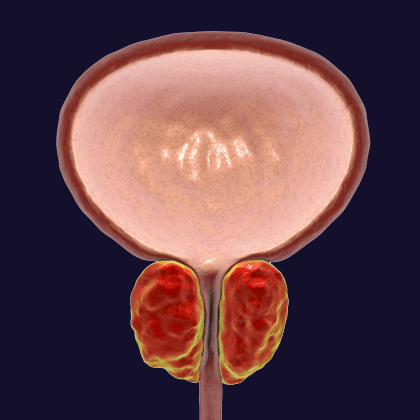Hiperplasia Prostatica